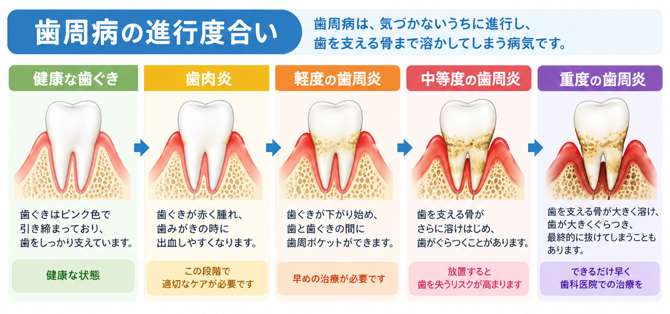 歯周病の進行度合い 健康な歯ぐきから重度の歯周炎までの図解